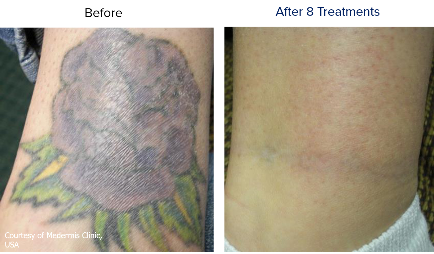 LASER TATTOO REMOVAL - Bare Element