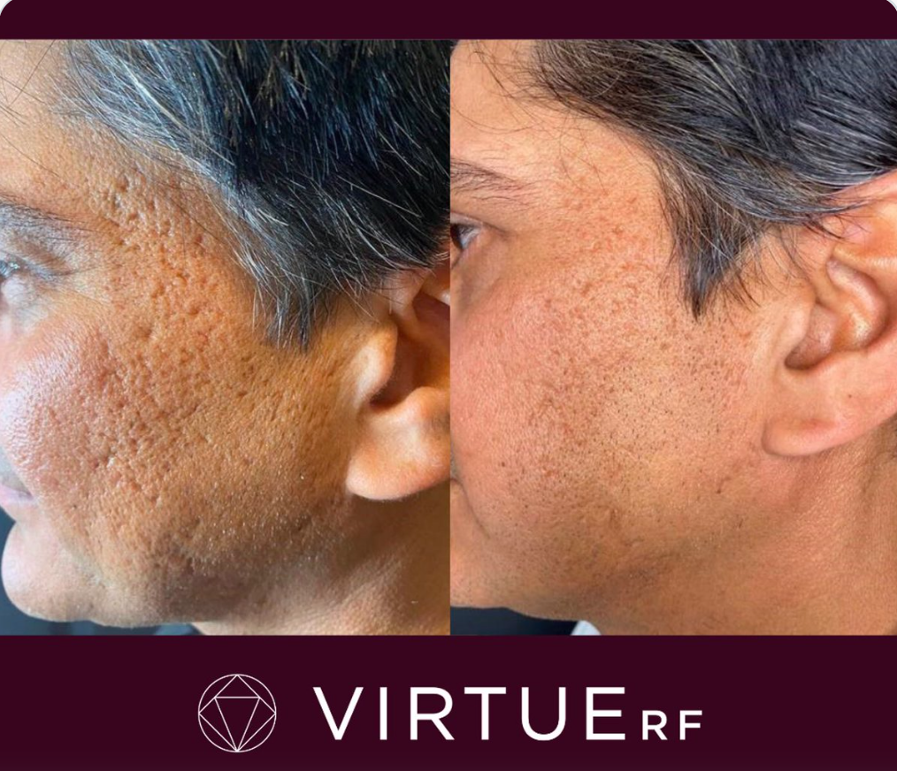 RF Microneedling