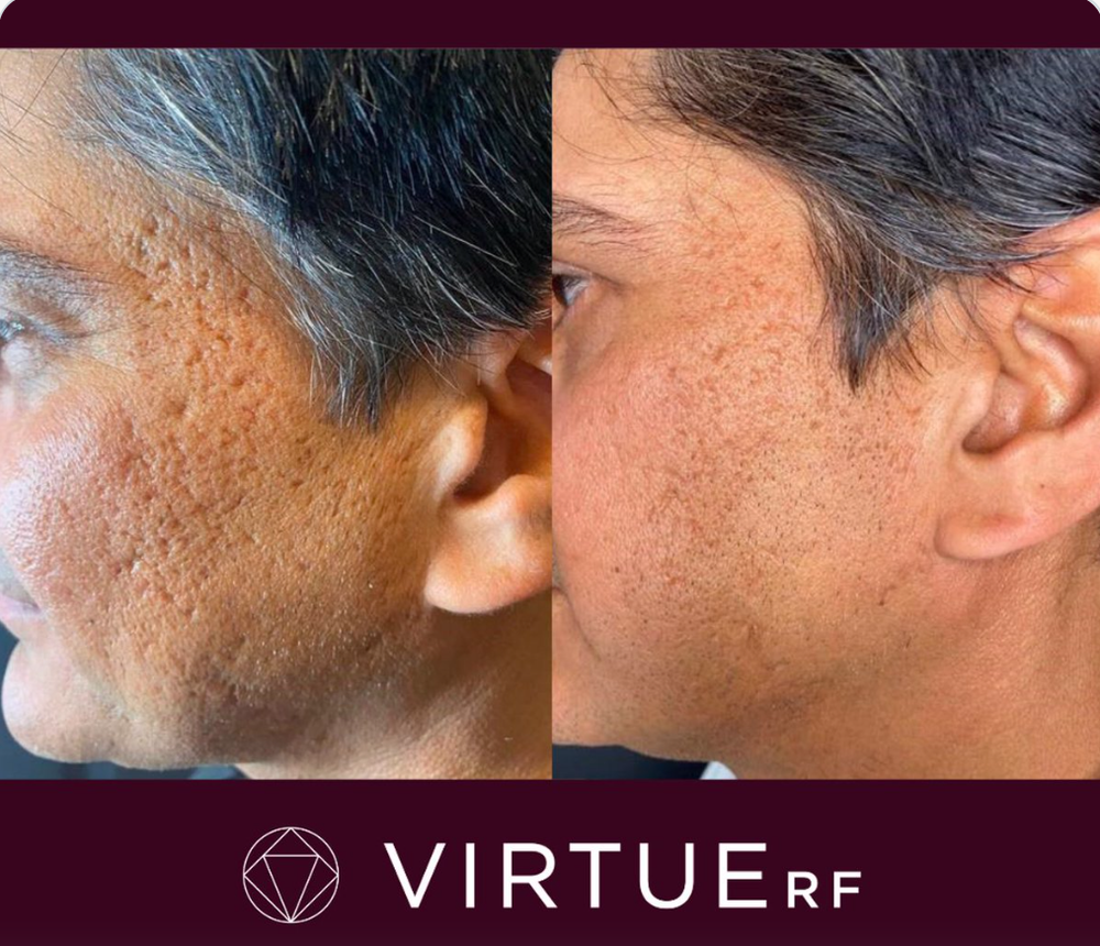 Virtue Rf Microneedling Skin Rejuvenation Method Rochester Ny Bare