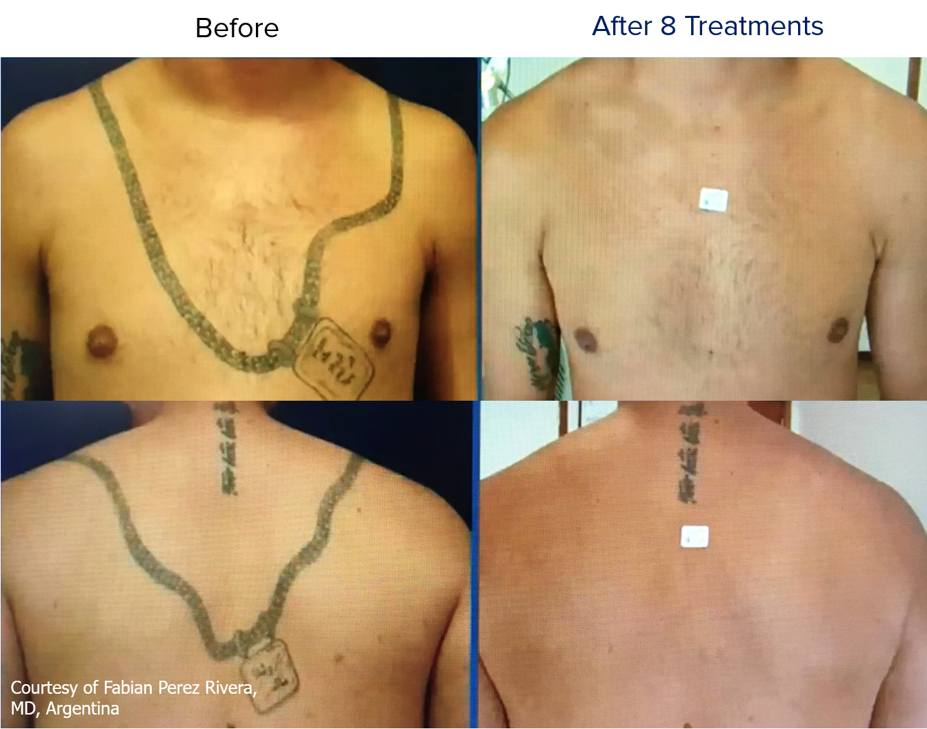 How much tattoo can laser tattoo removal really remove?