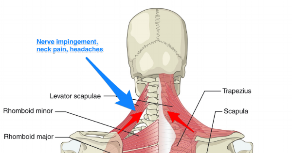 Chronic Upper Back Pain