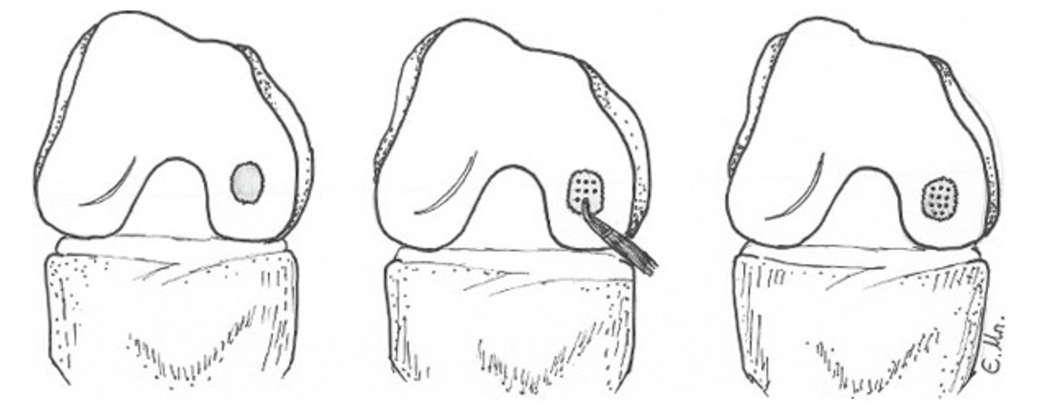 Microfracture — Amir Qureshi Orthopaedic Surgeon Knee Surgeon Southampton
