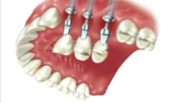 Placement of crowns on implants