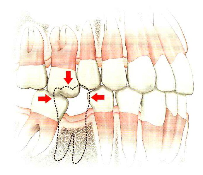 A missing tooth can make neighboring teeth shift or grow in the gap. 