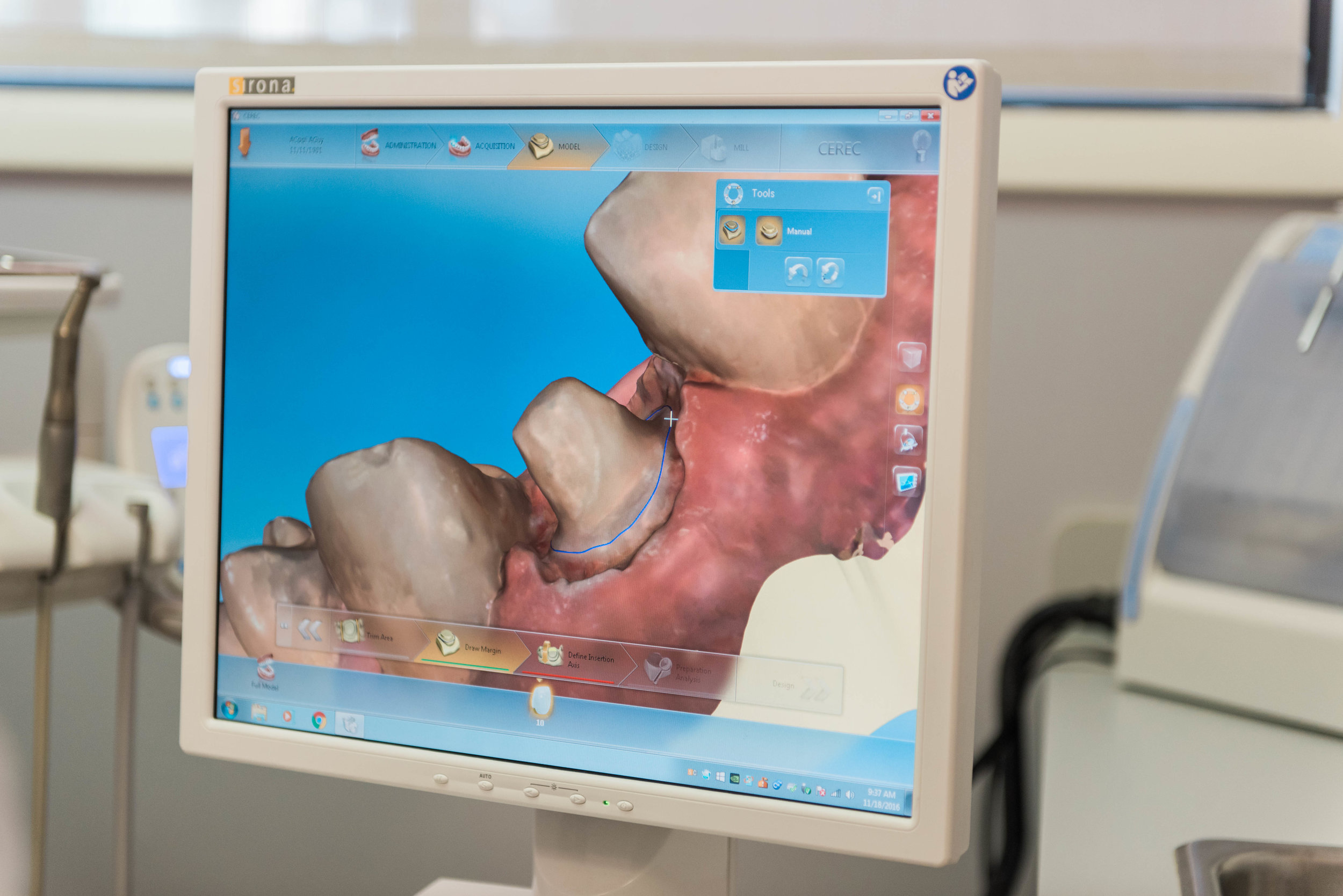 To make a CEREC crown, Dr. Mike takes a digital scan of the tooth after all damaged structure has been removed.