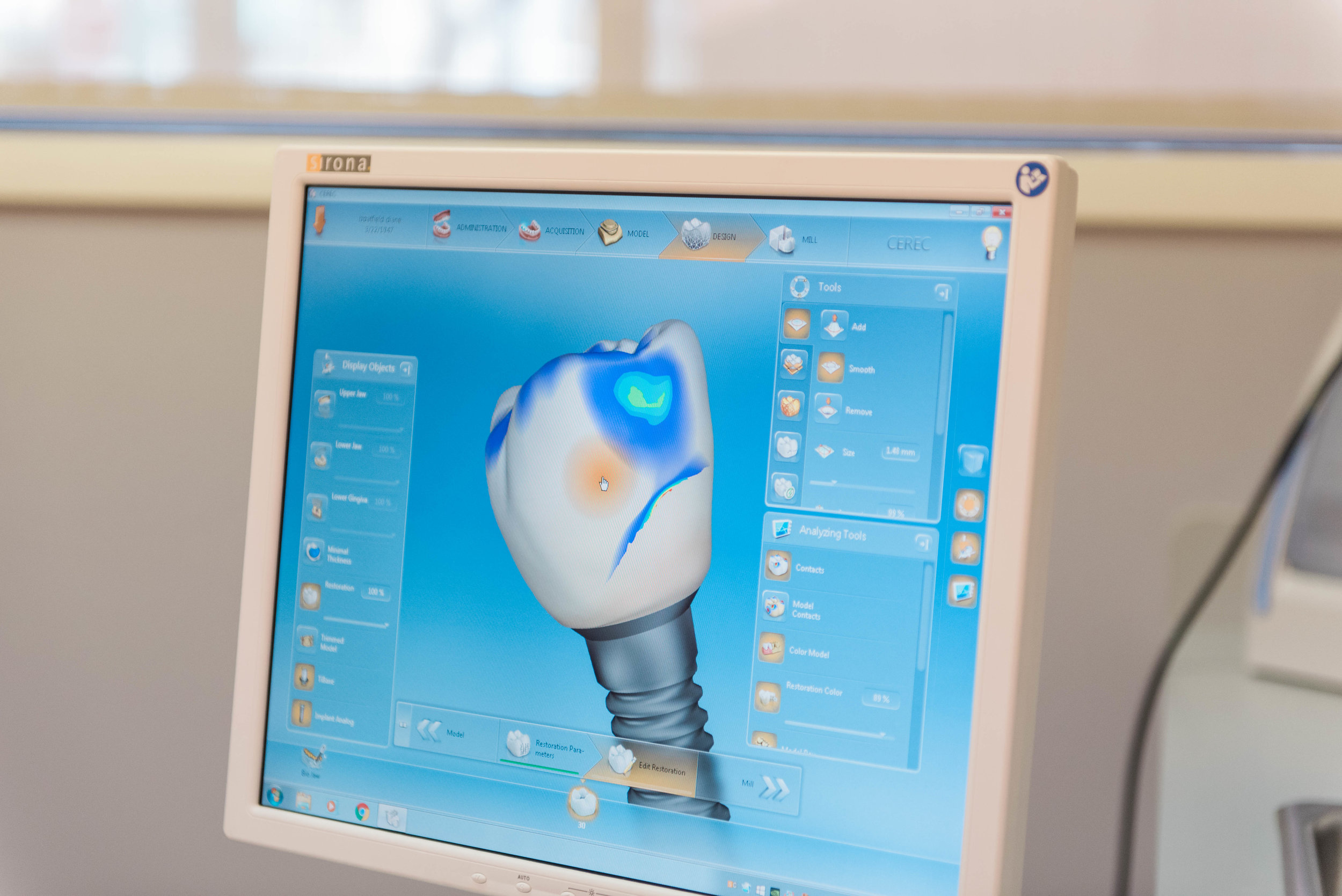 A single implant may be placed to replace a solitary tooth, or several implants may be placed to support a denture appliance.