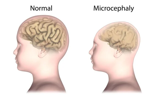 Zika infection causes developing cranial cells to secrete neurotoxic levels of immune molecules