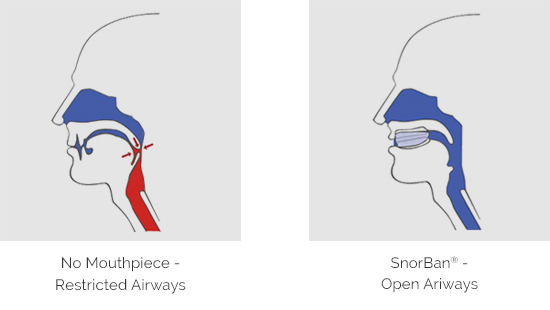 Diagram showing the difference in breathing through airways with and without the SnorBan mouthpiece