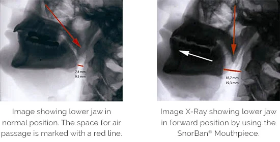 X-rays showing improved ability to breathe while using the SnorBan mouthpiece by lower jaw being brought forward