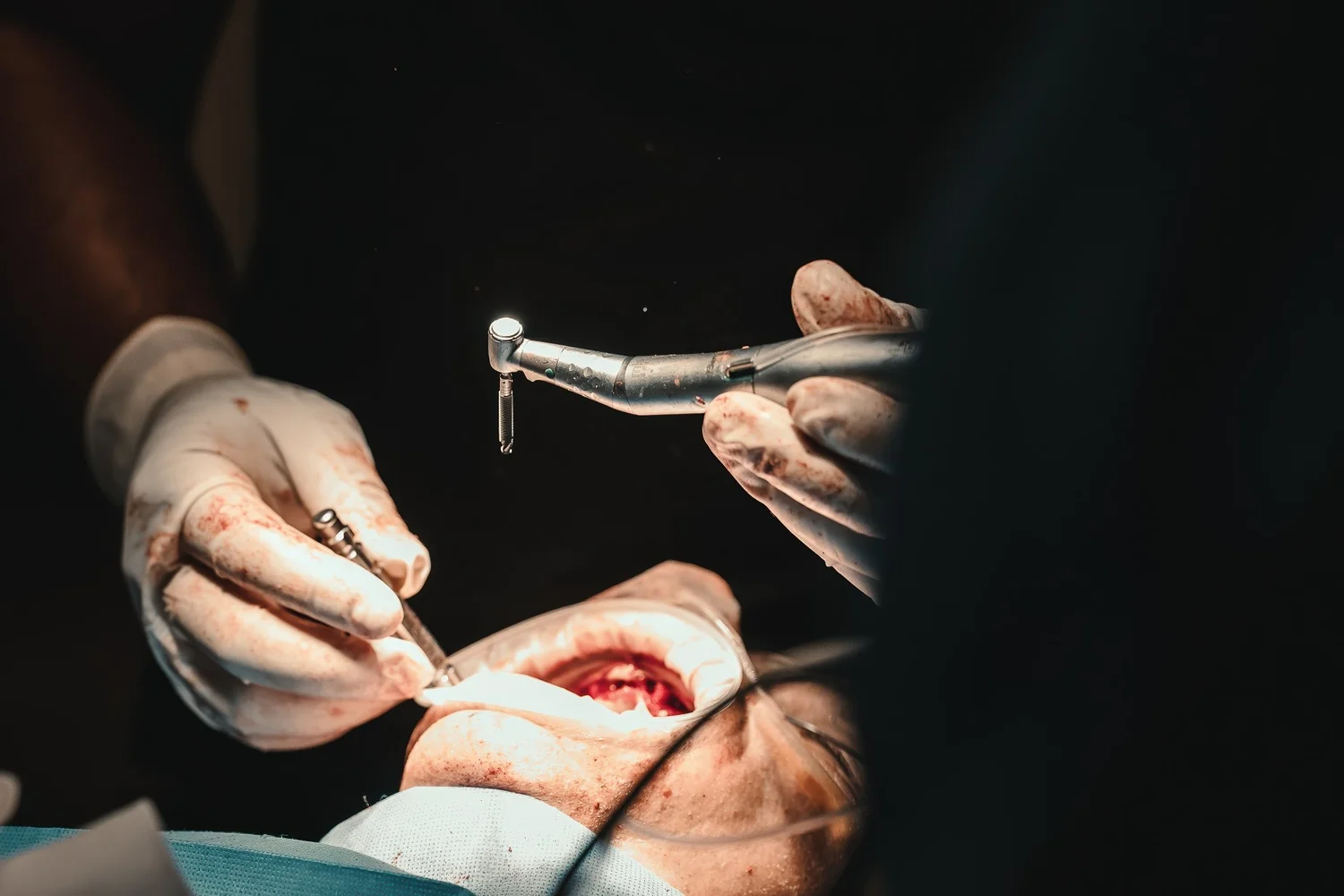 Dental procedure with handpiece, Pittsburgh oral surgery photography by Ian Jones