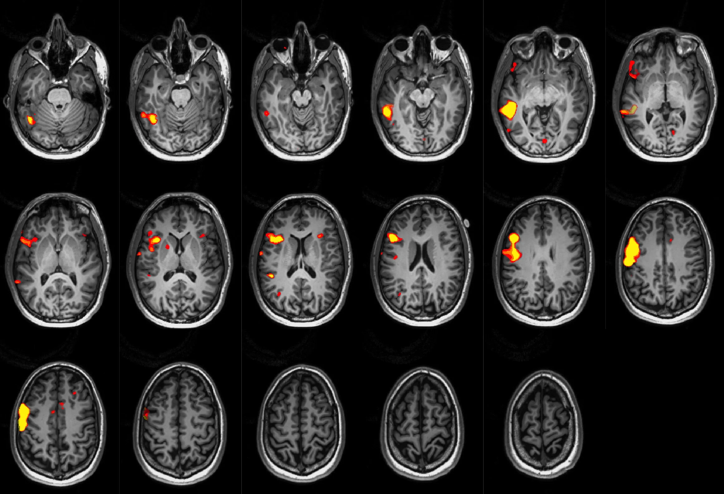 Language fMRI in a patient with right hemisphere dominance. Right of the image is the left of the brain (radiological conventions).