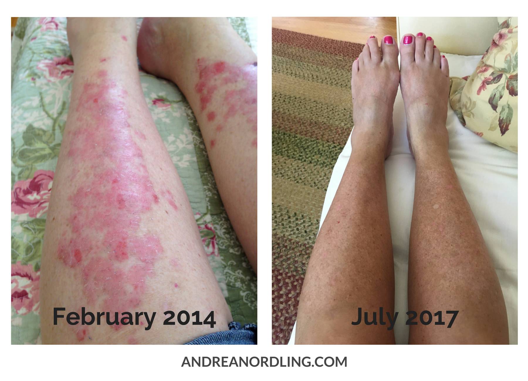 Psoriasis can be reversed! After trying every available topical treatment and cream for her autoimmune psoriasis and suffering for years, "Sally" finally reversed her symptoms by incorporating dietary changes and gut healing along with a few key nutrients. 