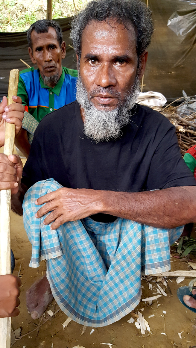 This elderly man was beaten by the Burmese military so severely that he has not been able to stop shaking since. Medical experts have suggested that his nerve endings may be damaged. The vast majority of Rohingya refugees who survived the journey to Bangladesh have severe health complications. However, the local hospital is very small and can only accommodate a small fraction of the injured.