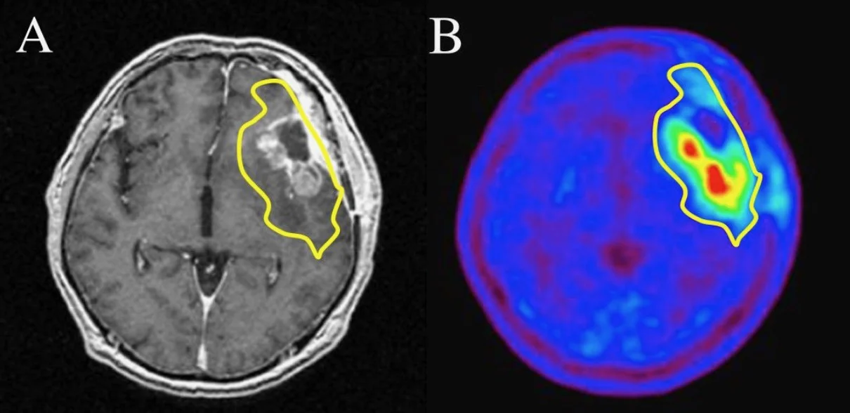 A: Magnetic resonance image (MRI) showing a Glioma. B: Positron emission tomography (PET) image, showing relatively increased cell metabolism in red and yellow areas. For information on when and how PET scans are used, read more here.