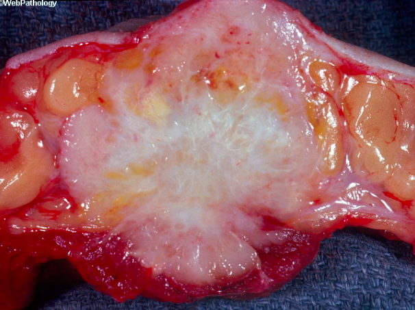 The photo from Web Pathology shows the hard, grayish, white appearance of infiltrating ductal carcinoma. Microcalcifications within the mass will often lead to a gritty appearance. The yellow-white portions of necrosis can also be seen.