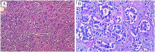 Tubular carcinoma