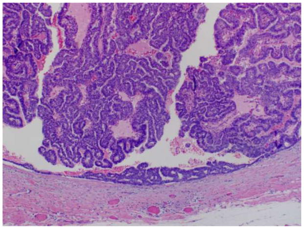 papillary .jpg