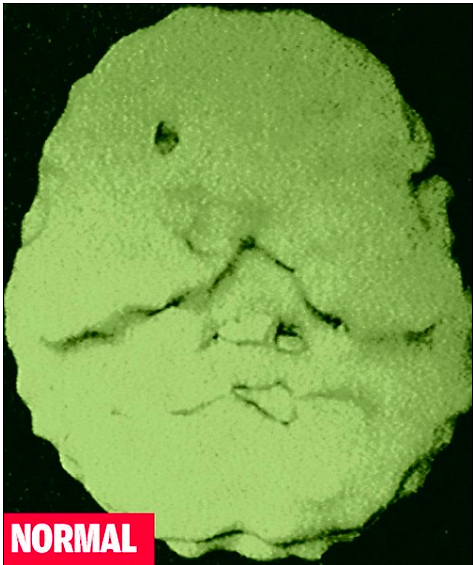 Normal blood flow seen in healthy brain as a comparison to others. (photos courtesy of AMEN clinics)