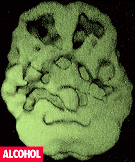 Marked decrease in Prefrontal Cortex: too much or too little activity in this area makes you unpredictable and moody
