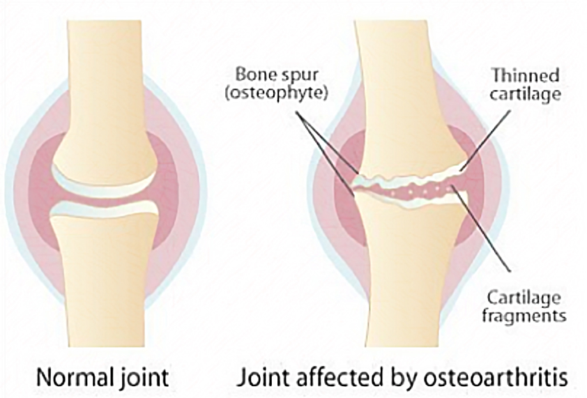 váll osteoarthritis 2. fokozatú rheumatoid arthritis