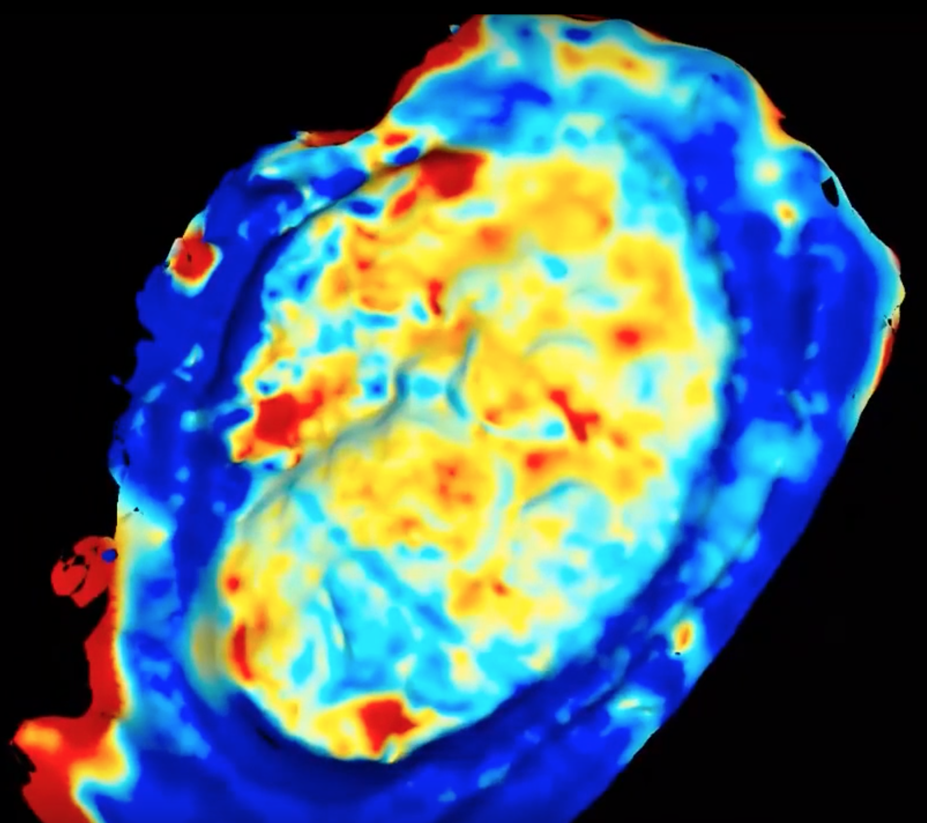 During surgery, our uniquely-capable 3D optical scanner will continually track sub-mm changes to the exposed brain. We will use this data to update the model, simulating brain shift.