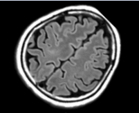Preoperative MRI