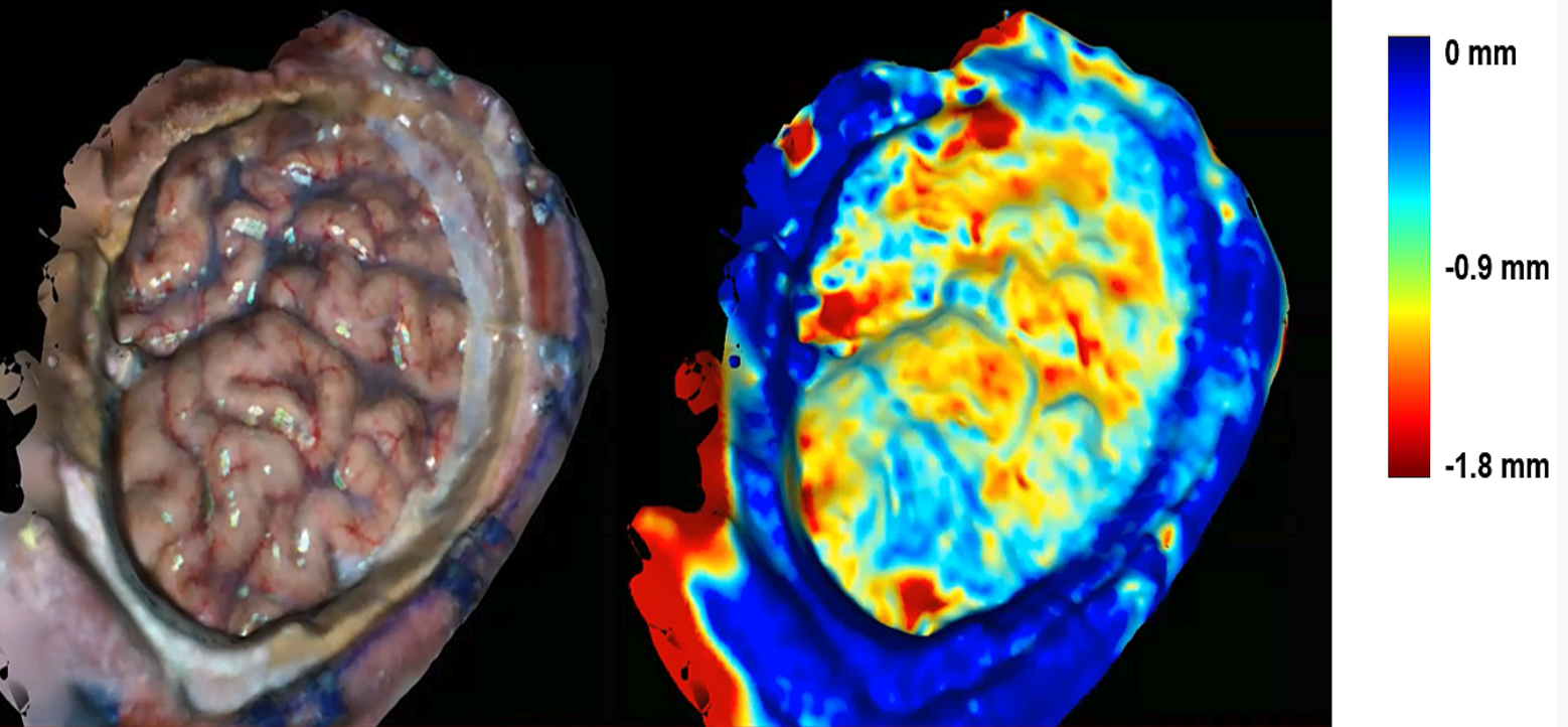 Intraoperative optical scan