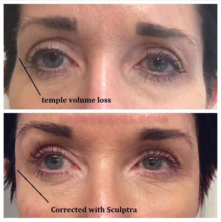 Lifting the Face by Filling the Temples with Sculptra — Nurse Gigi