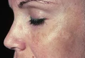 Melasma: An Ongoing Battle For Many Women