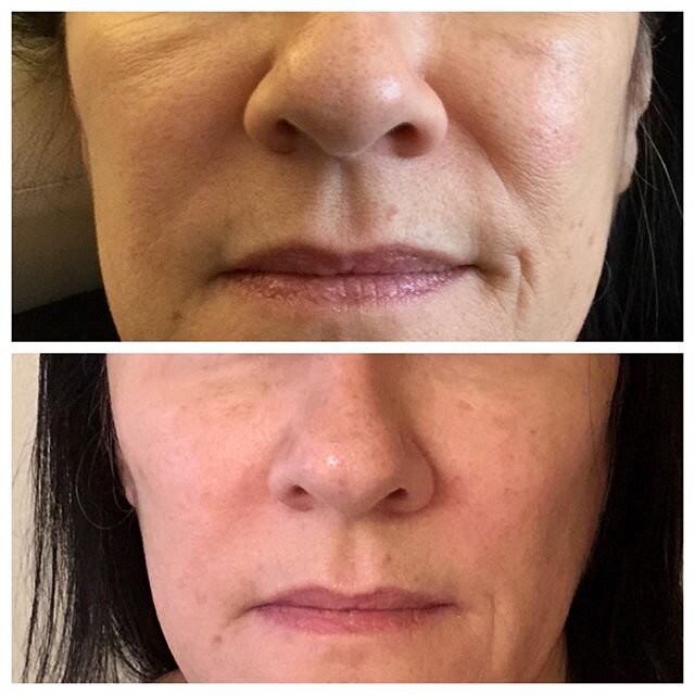 ✨Mid-face volume restored with Restylane Lyft 💉⠀
1.) 😷Procedure: Restylane Lyft 1cc x 3 syringes ⠀
2.) ⏰ Time: 30 Minutes
3.) 🔁 Repeat every year or as needed ⠀
4.) 📆 Recovery: bruising + swelling 1-7 days ⠀
5.) 💵 Cost:starts at $800 per syringe
