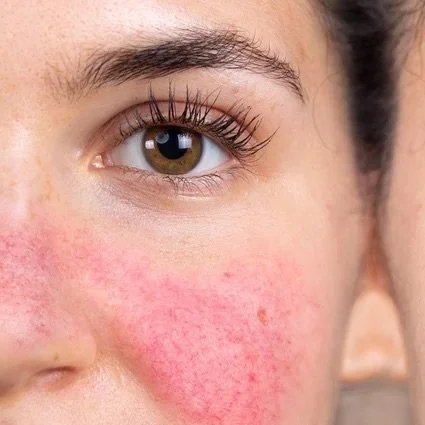 April is Rosacea Awareness Month