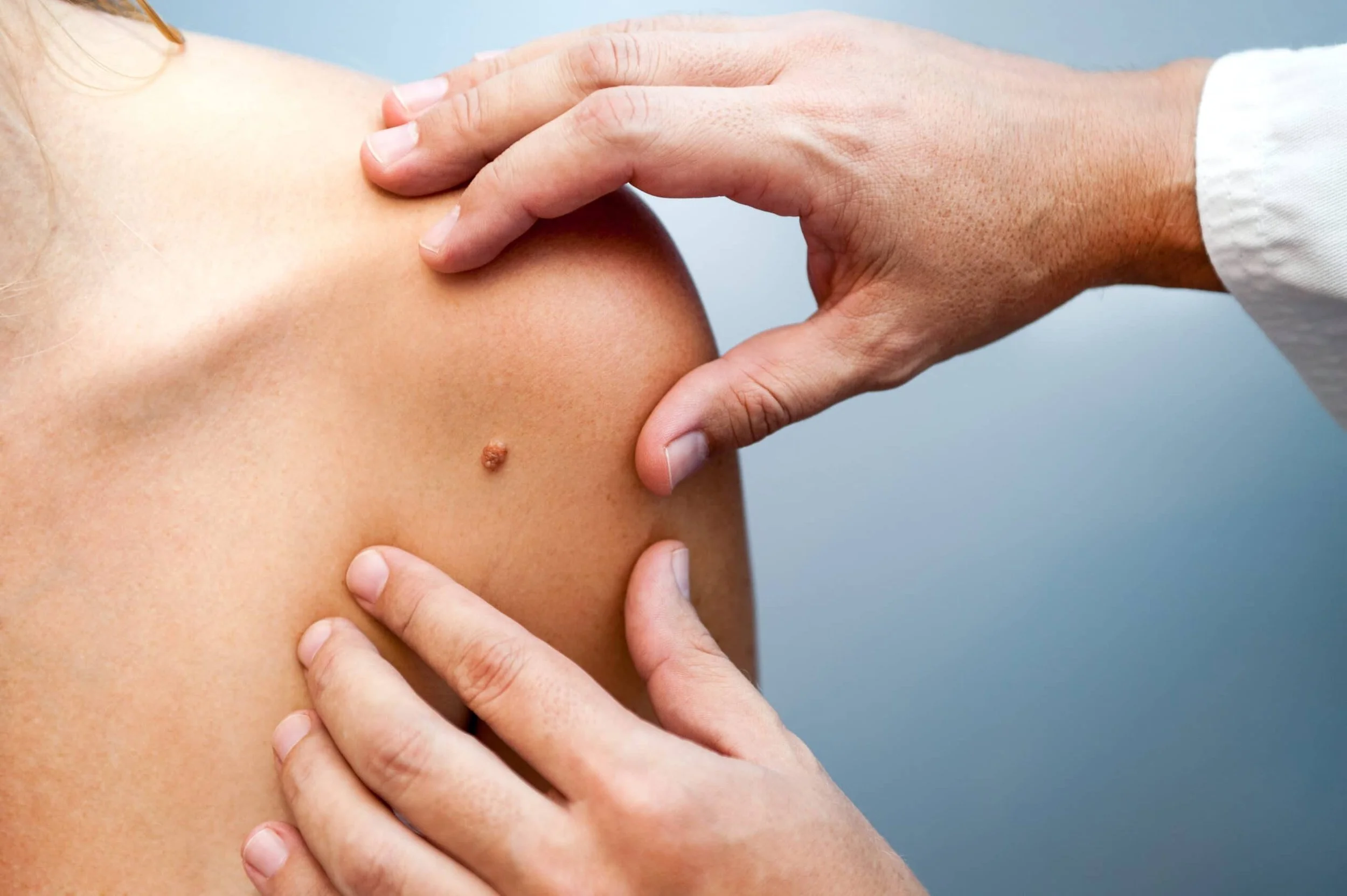 May is Skin Cancer Awareness Month