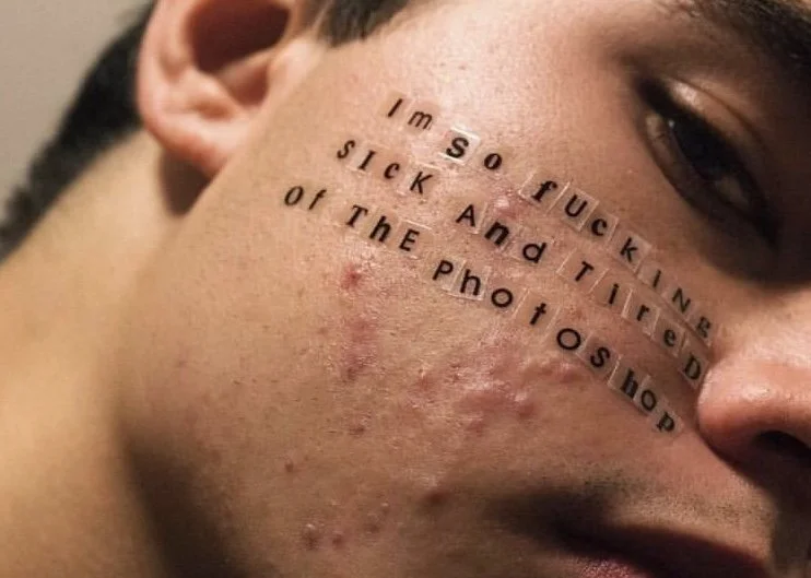 June is Acne Awareness Month