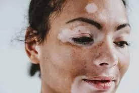 Vitiligo Explained