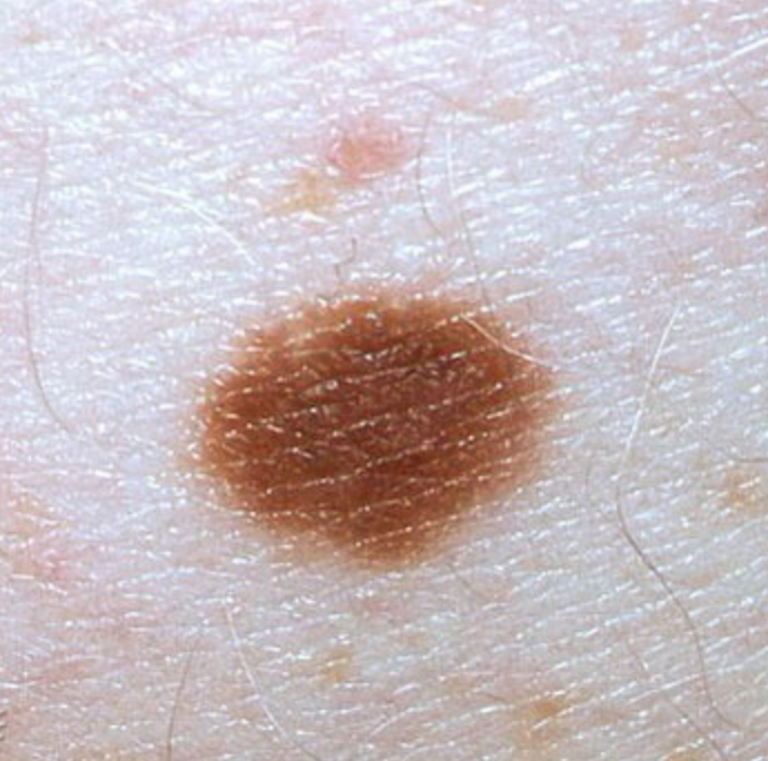 Benign Moles Benign Moles