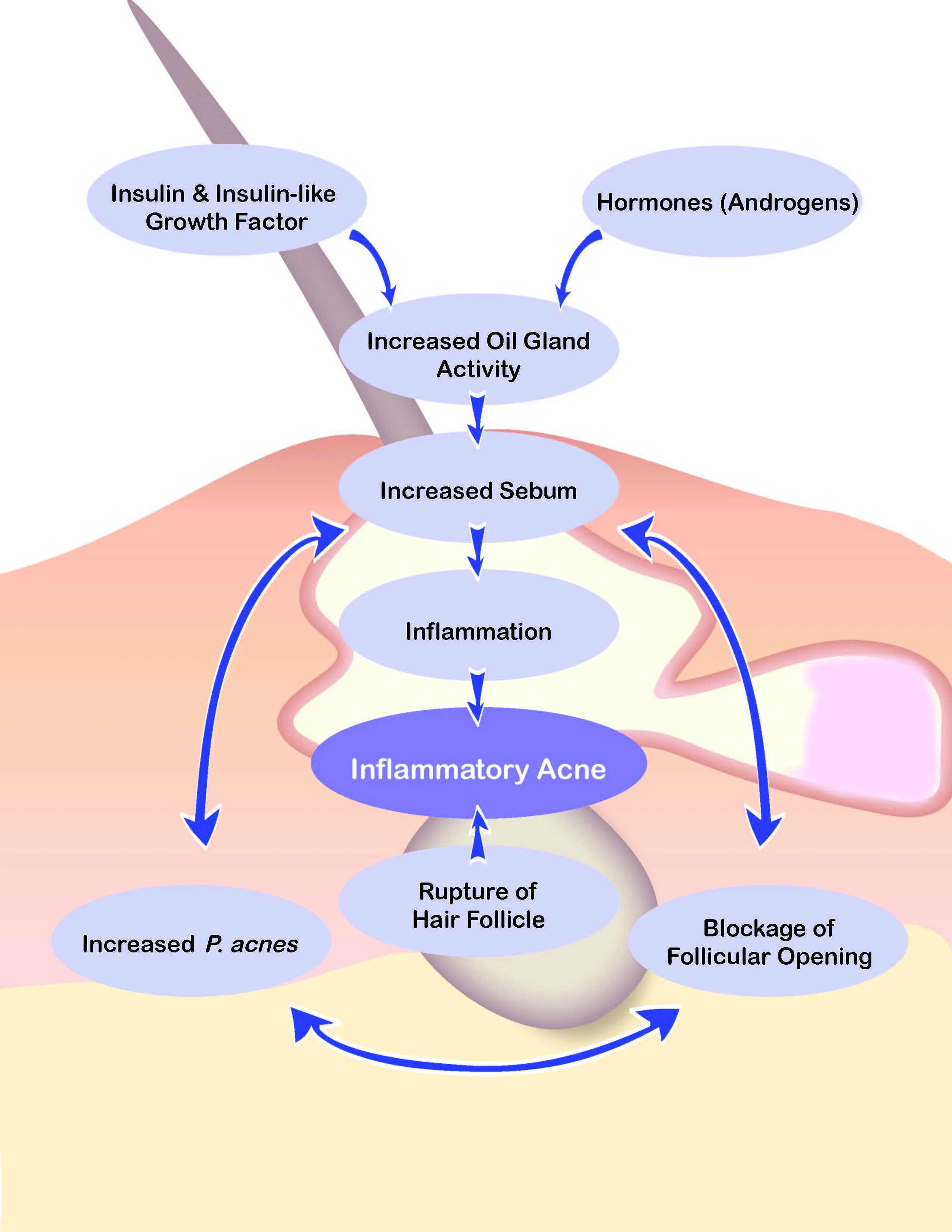 Can Male Hormones Cause Acne Acne In Men Causes And Treatments IRCI