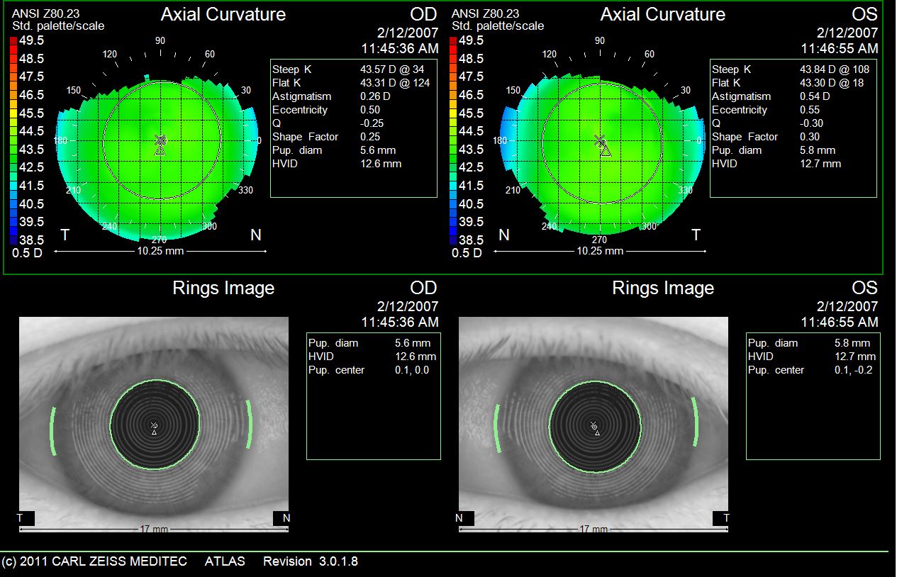 normalcornea.JPG