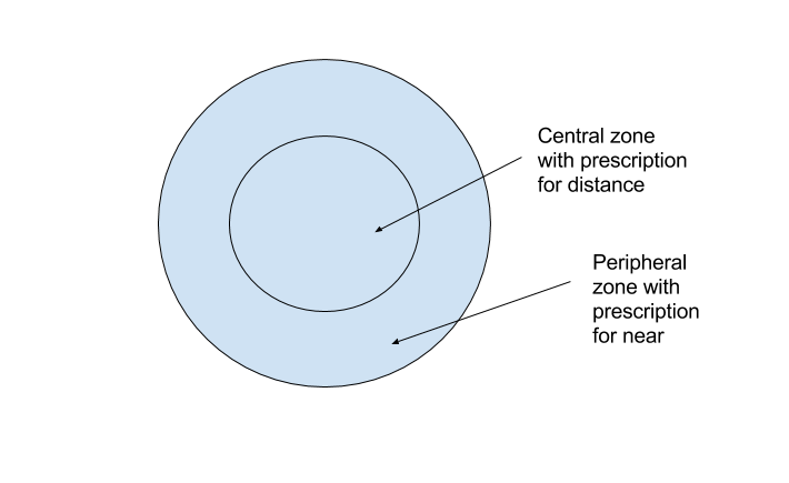 Bifocal contact lenses have two different prescriptions in the lens, one in the periphery and one in the centre of the lens. This allows them to focus peripheral images differently than central images.