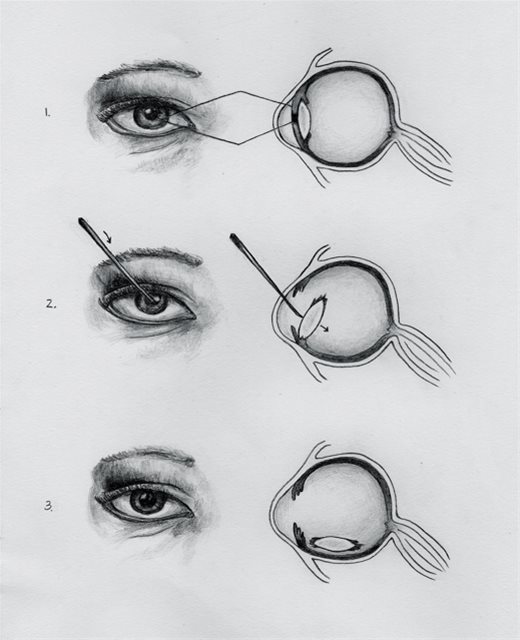 Couching procedure has been around since atleaset 600 BC, and is still practiced in certain areas of Africa, where a needle or thorn is used to push the catarct out of the way. The risk of blindness can apporach 80%.