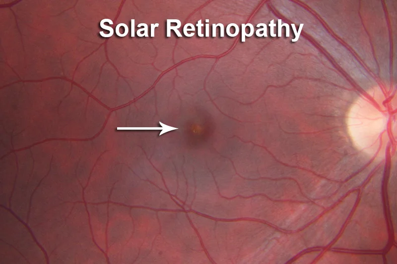 Permanent damage to the retina (yellow lesion).
