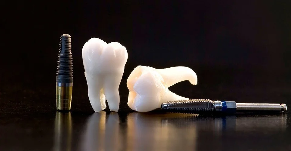 Implant-960x500.jpg