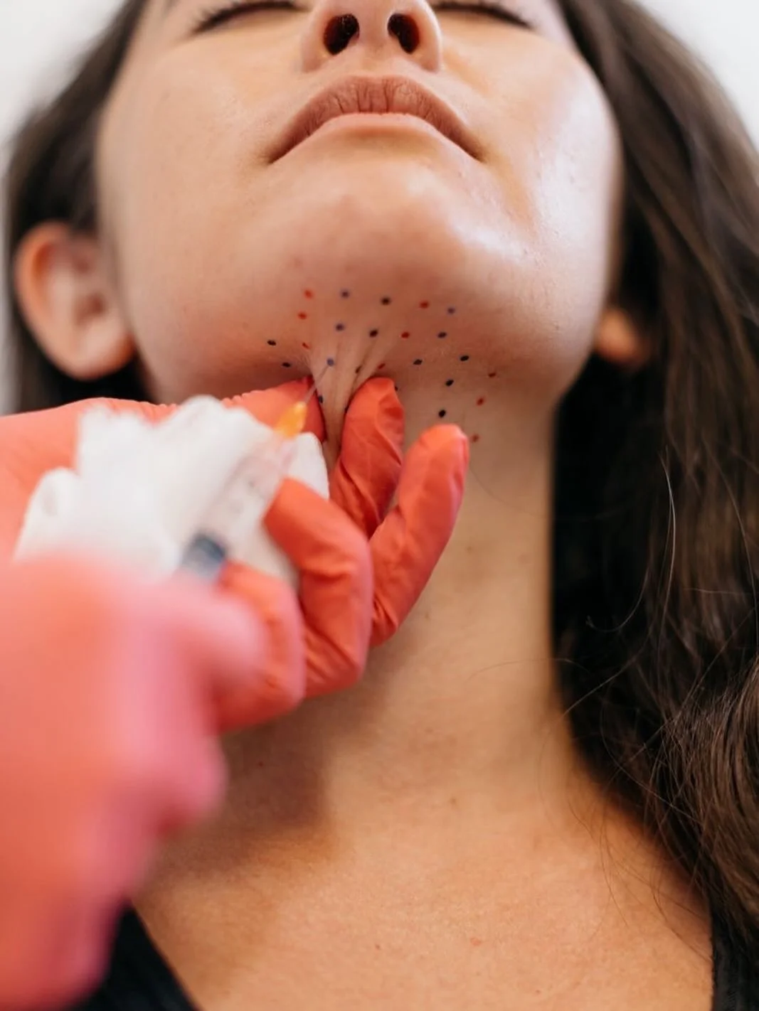 Say goodbye to stubborn under-chin fullness with Belkyra! 💉 
.
.
.
.
This treatment works by breaking down and permanently eliminating fat cells under the chin for a slimmer, more defined profile. Most people need 2&ndash;4 sessions for best results