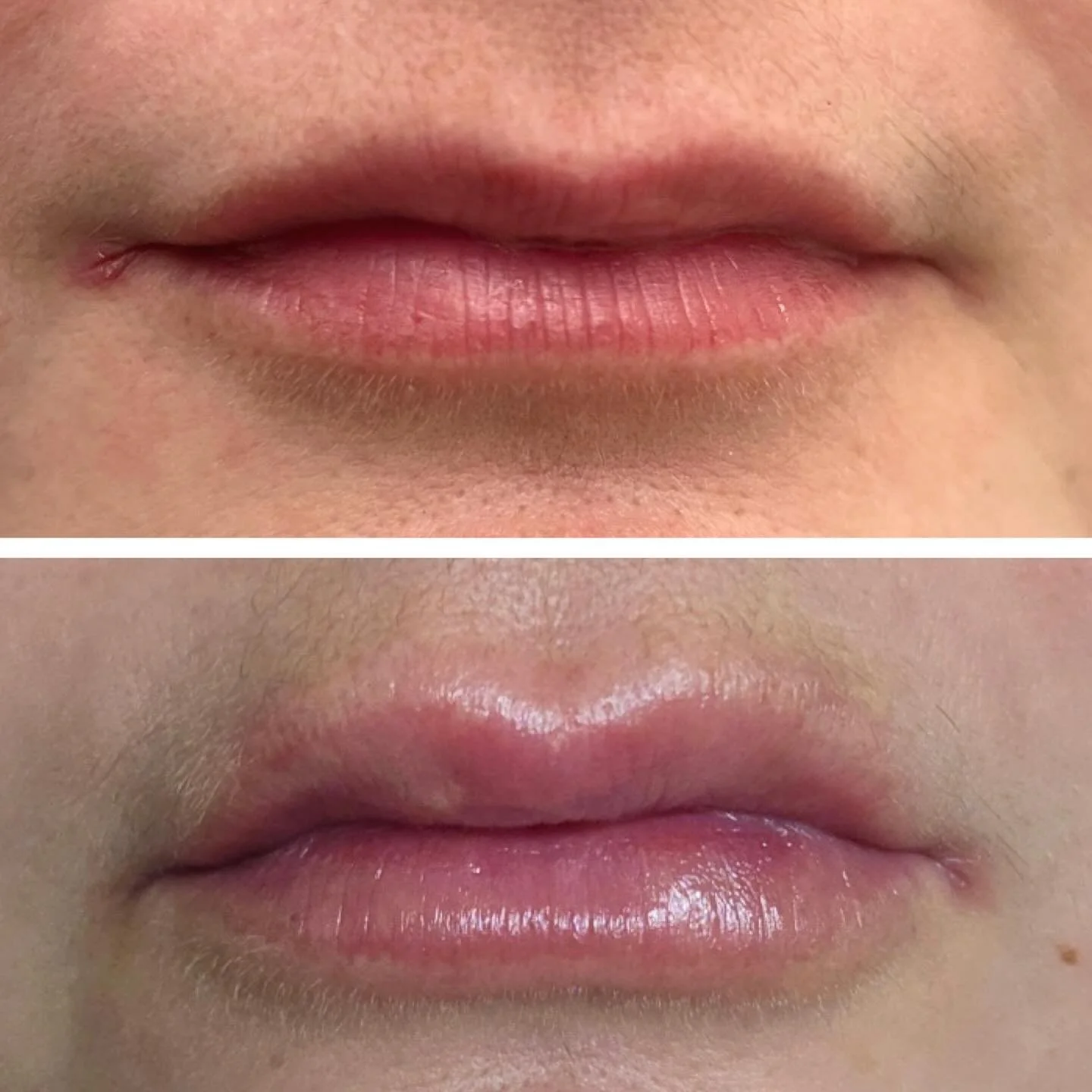 💋 The Perfect Pair: Lip Filler + Lip Flip
.
.
.
.
Lip filler is one of the best ways to enhance volume, define your shape, and balance your features. It adds soft, natural fullness while smoothing fine lines around the lips for a hydrated, youthful 