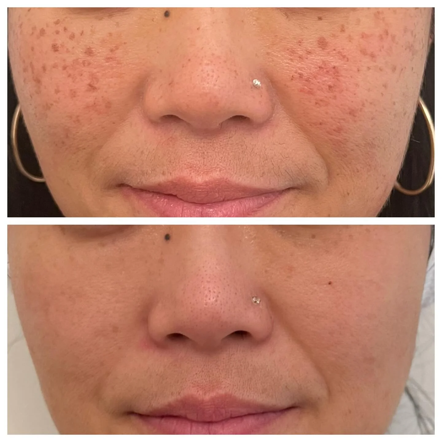 Why we love the BBL/Moxi combo!💥

When done in the same session or close together, BBL clears visible discoloration while MOXI enhances cellular renewal beneath the surface. This &ldquo;top-down and bottom-up&rdquo; effect makes the skin brighter, s