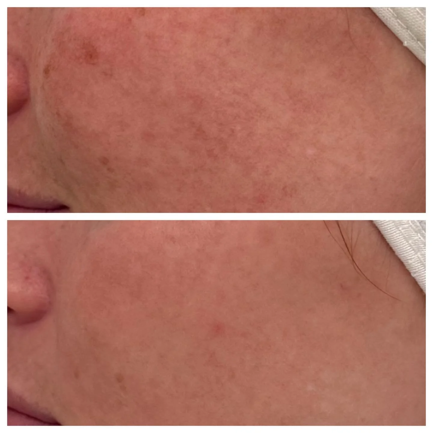 BBL + Moxi stack treatment&mdash;the ultimate duo for brighter, smoother, and younger-looking skin! ☀️🌿

🔹 BBL (BroadBand Light) targets sun damage, redness, and pigmentation, leaving your skin clear and even-toned.
🔹 Moxi is a gentle fractional l