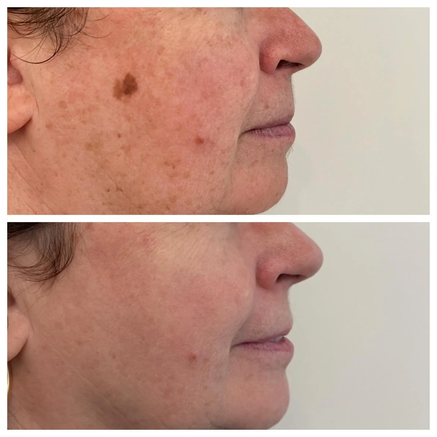Clearer, brighter skin starts with BBL &mdash; a powerful solution for stubborn sunspots. 🌞

This client had a series of BBL treatments in 2024, and a BBL/Moxi stack in 2025. 
This is why we love to have a treatment plan. 
Now It&rsquo;s all about m