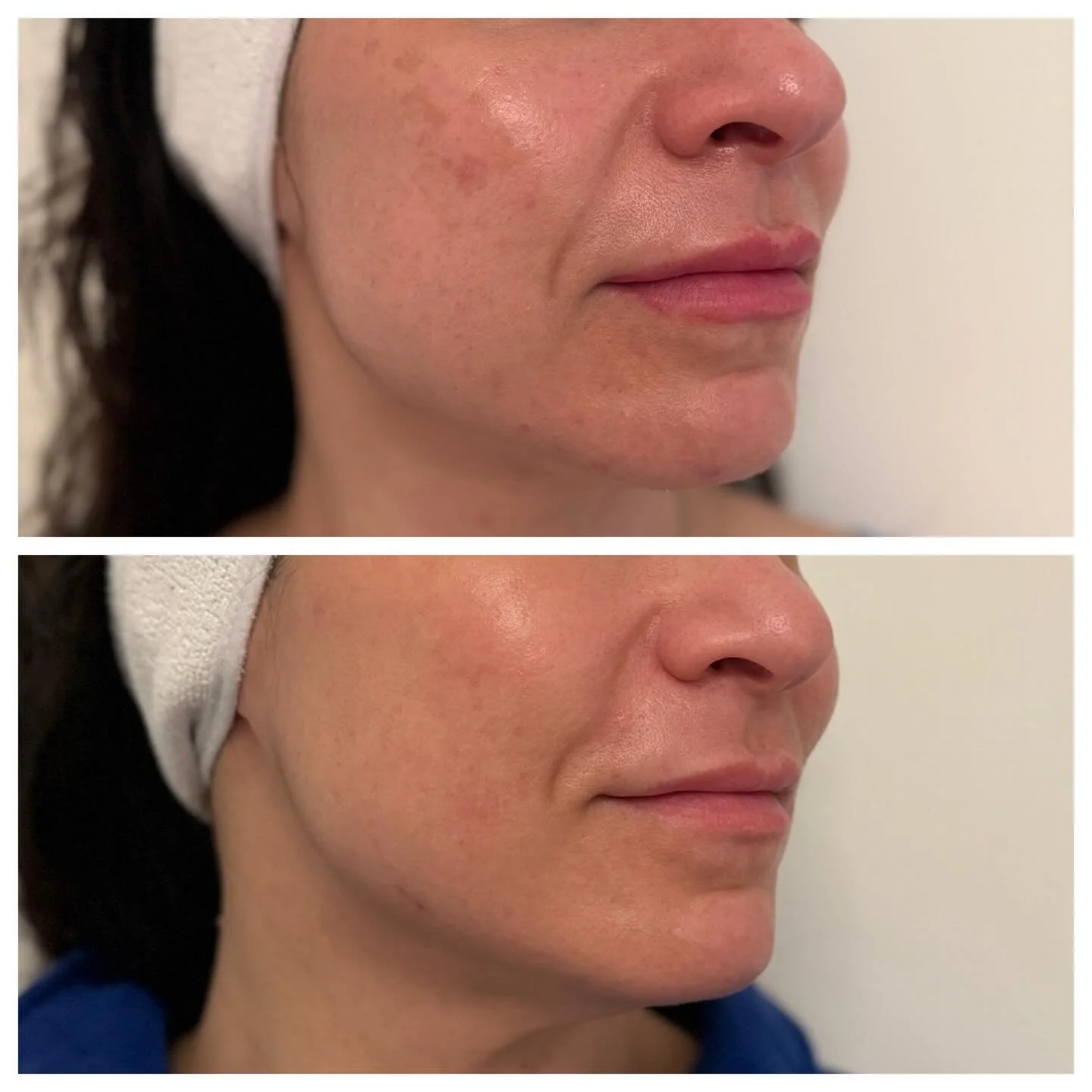 Melasma? Not here! This is after a series of just  2 BBL/MOXI  stack treatments. 
.
.
.
.
Together, these treatments target unwanted pigment while also improving overall skin tone and texture. BBL works to break up excess pigmentation and calm visibl