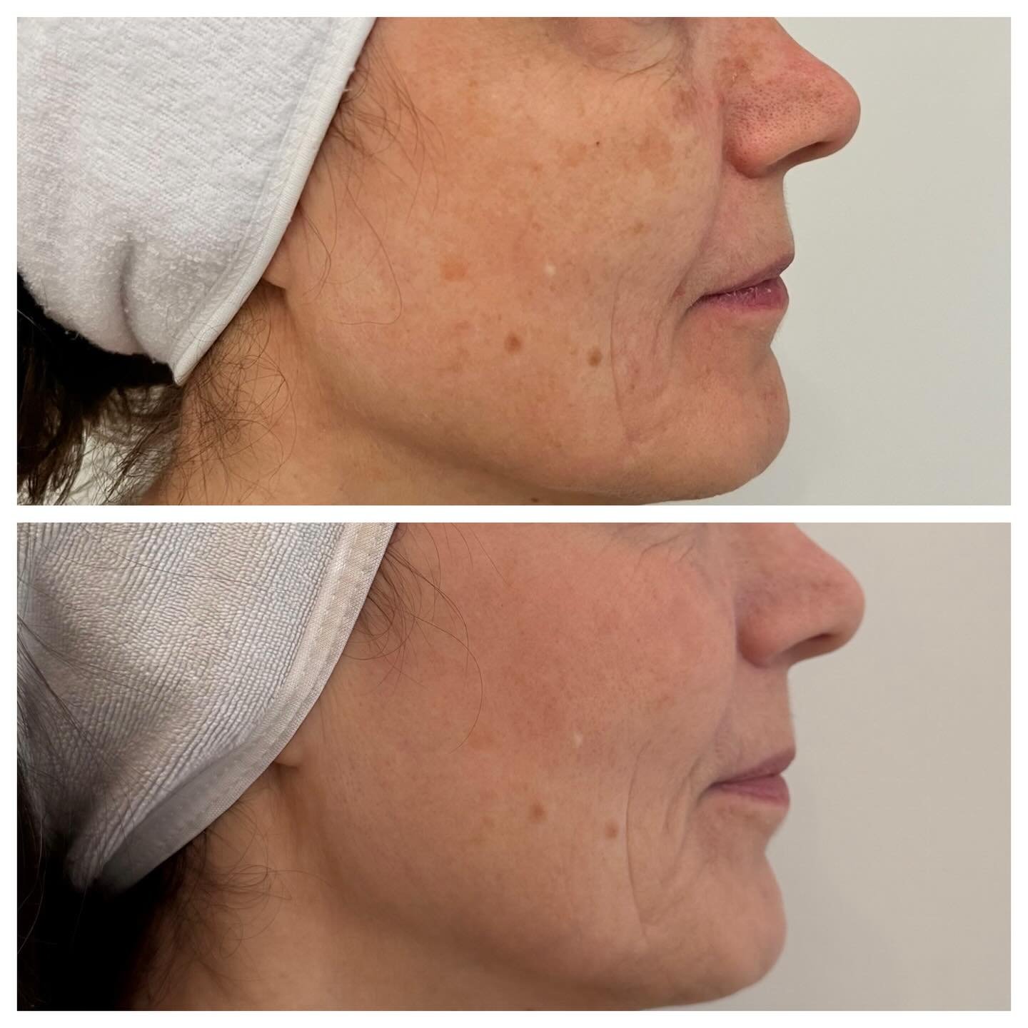 Clearer, brighter skin you can actually see ✨
.
.
.
.
Our BBL + Moxi treatment works beneath the surface to target sun damage, uneven tone, and pigmentation&mdash;helping fade dark spots and reveal smoother, more even-looking skin.

This before &amp;