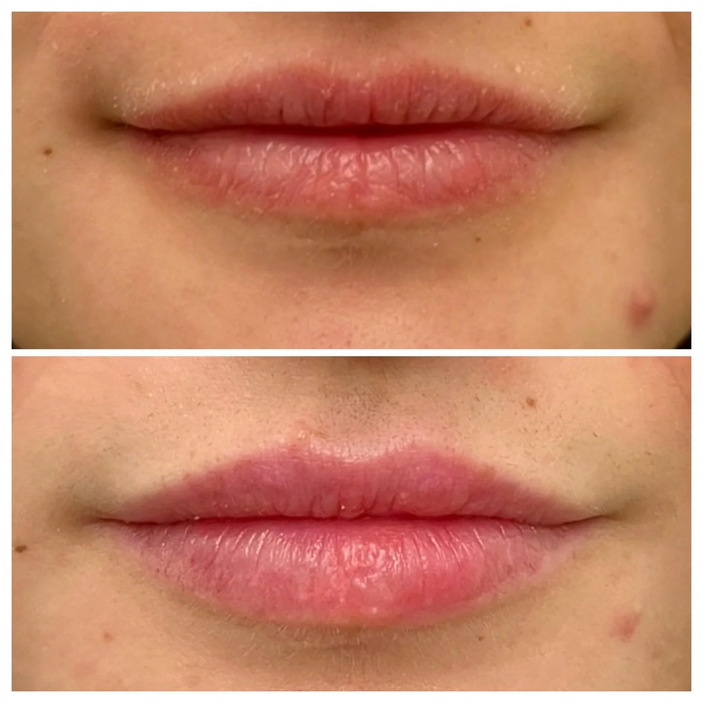 Before &amp; After 😙
.
.
.
. A little lip filler can make a big difference 💉💋 Our goal is always natural enhancement, restoring volume, balancing proportions, and adding subtle definition while keeping your lips uniquely you.

This gorgeous result