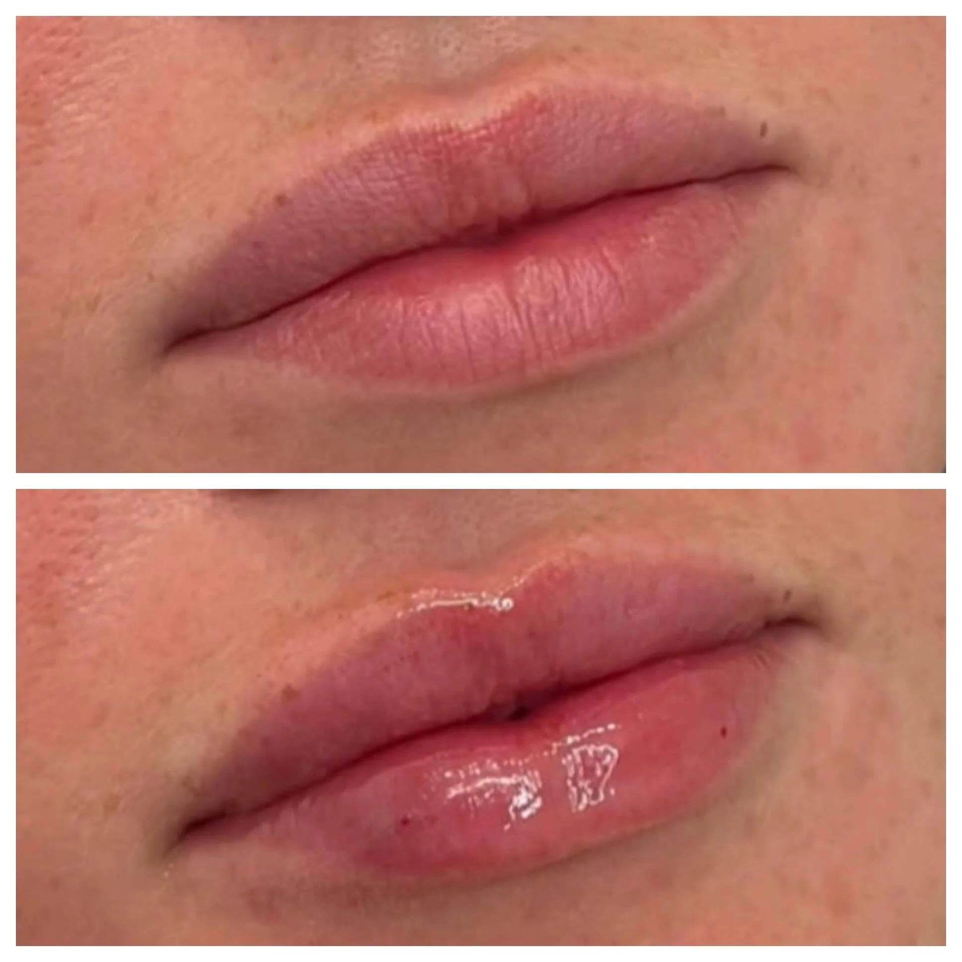 Before &amp; After 😙
.
.
.
. A little lip filler can make a big difference 💉💋 Our goal is always natural enhancement, restoring volume, balancing proportions, and adding subtle definition while keeping your lips uniquely you.

This gorgeous result